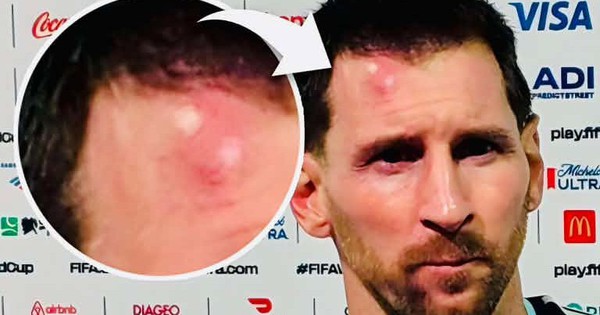 Messi sưng vêu trán sau trận thắng Cabo Verde: Chấn thương nhỏ không ngăn siêu sao tỏa sáng - hình ảnh - vipjun88.com Messi sưng vêu trán sau trận thắng Cabo Verde: Chấn thương nhỏ không ngăn siêu sao tỏa sáng - hình ảnh - vipjun88.com